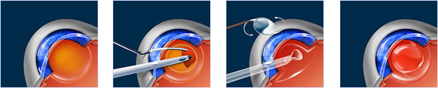 cataract surgery